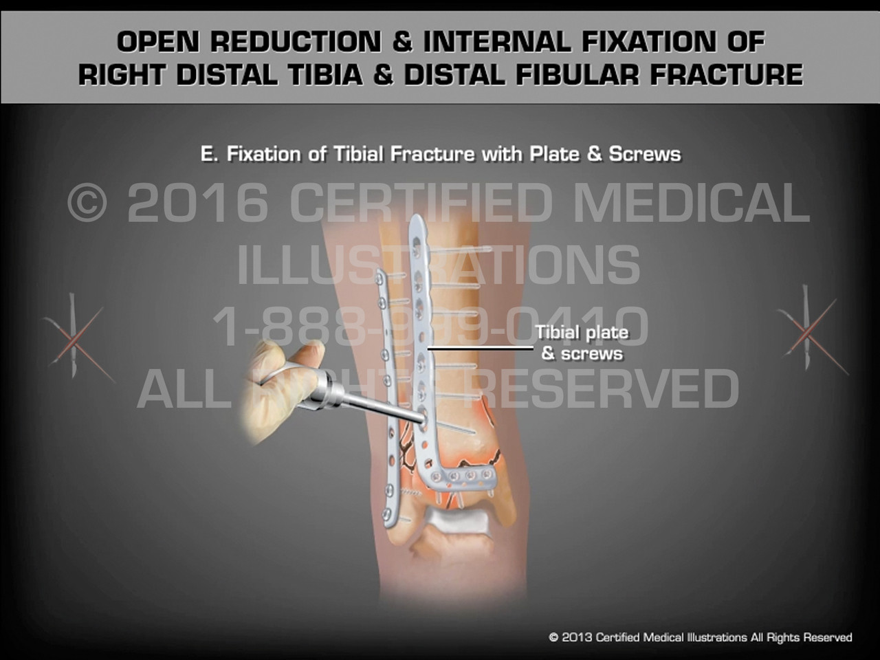 Open Reduction & Internal Fixation of Right Distal Tibia & Distal ...