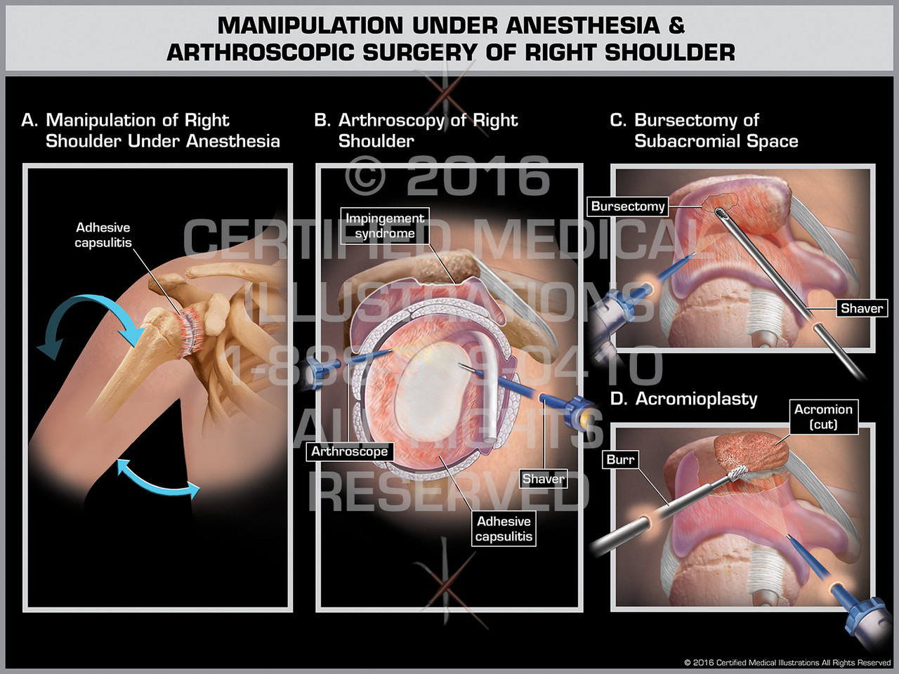 Manipulation Under Anesthesia & Arthroscopic Surgery of Right Shoulder