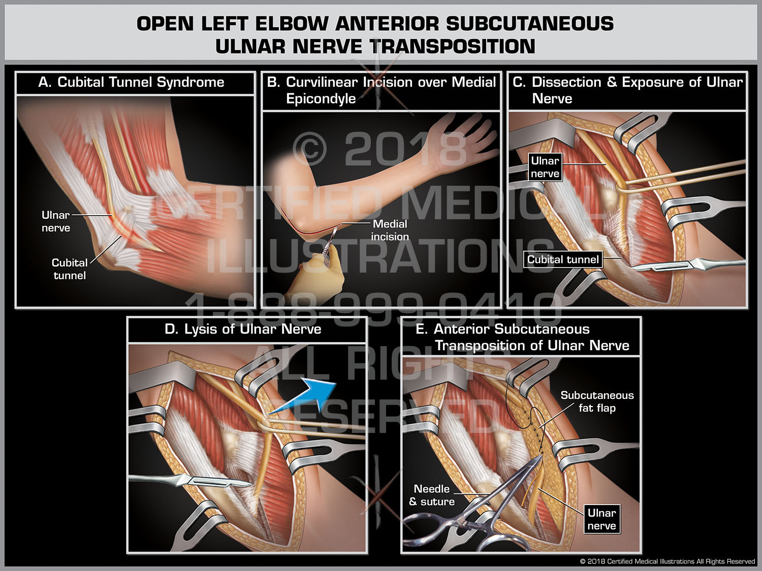 Open Left Elbow Anterior Subcutaneous Ulnar Nerve Transposition - Print ...