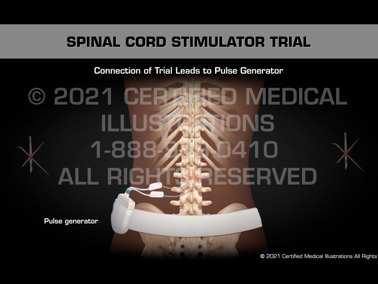 Spinal Simulator Controller Spinal Cord Stimulator Trial - Medical Animation