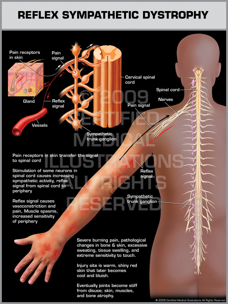 Reflex Sympathetic Dystrophy Upper Limb