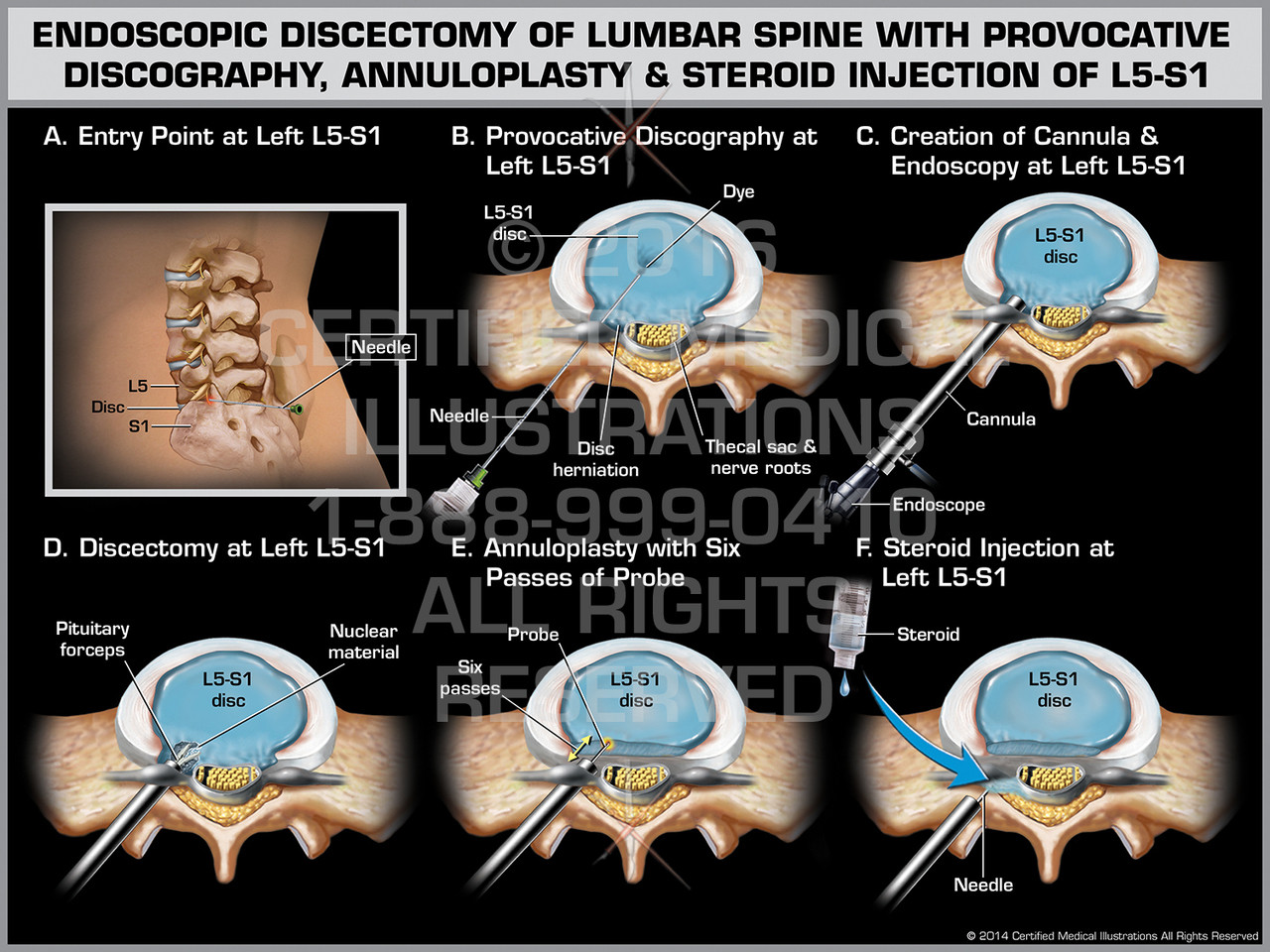 Discography Injection Endoscopic Discectomy of Lumbar Spine with Provocative Discography ...