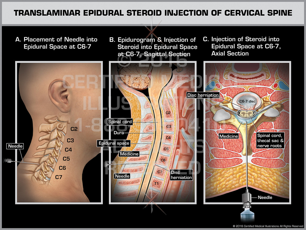 Translaminar Epidural Steroid Injection of Cervical Spine Male