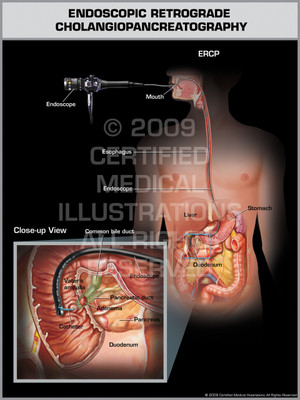 Endoscopic Retrograde Cholangiopancreatography (Male) Endoscopic Retrograde Cholangiopancreatography (Male)