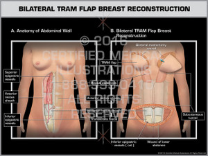 Exhibit of Bilateral TRAM Flap Breast Reconstruction 1 - Print Quality Instant Download Exhibit of Bilateral TRAM Flap Breast Reconstruction 1 - Print Quality Instant Download