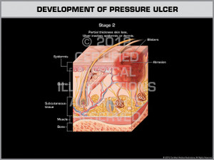 Exhibit of Development of Pressure Ulcer - Stage 2