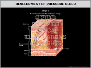 Exhibit of Development of Pressure Ulcer - Stage 3 Exhibit of Development of Pressure Ulcer - Stage 3