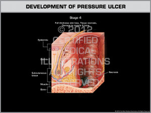 Exhibit of Development of Pressure Ulcer - Stage 4 Exhibit of Development of Pressure Ulcer - Stage 4