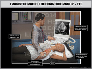 Exhibit of Transthoracic Echocardiography- TTE Female Exhibit of Transthoracic Echocardiography- TTE Female