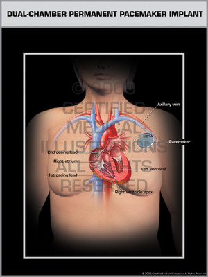 Exhibit of Dual-Chamber Permanent Pacemaker Implant Female