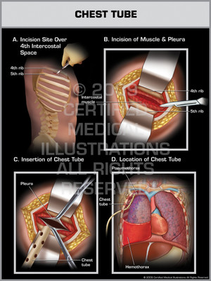 Exhibit of Chest Tube Male Exhibit of Chest Tube Male