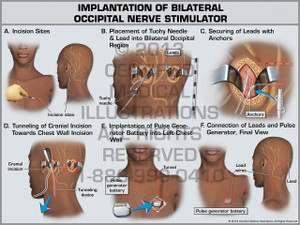 Exhibit of Implantation of Bilateral Occipital Nerve Stimulator Exhibit of Implantation of Bilateral Occipital Nerve Stimulator