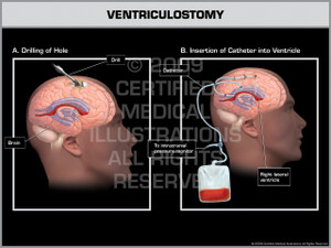 Exhibit of Ventriculostomy Male