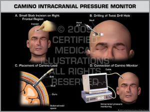 Exhibit of Camino Intracranial Pressure Monitor Male Exhibit of Camino Intracranial Pressure Monitor Male