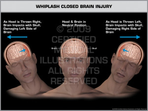 Exhibit of Whiplash Closed Brain Injury Male Exhibit of Whiplash Closed Brain Injury Male