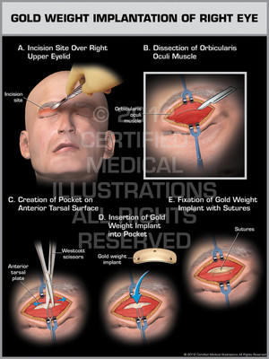 Exhibit of Gold Weight Implantation of Right Eye Exhibit of Gold Weight Implantation of Right Eye