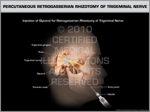Percutaneous Retrogasserian Rhizotomy of Trigeminal Nerve Female Percutaneous Retrogasserian Rhizotomy of Trigeminal Nerve Female