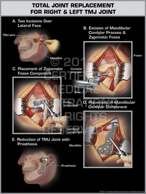 Exhibit of Total Joint Replacement for Right & Left TMJ Joint Exhibit of Total Joint Replacement for Right & Left TMJ Joint