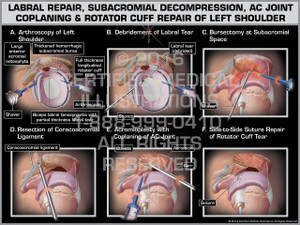 Exhibit of Labral Repair, Subacromial Decompression, AC Joint Coplaning & Rotator Cuff Repair of Left Shoulder - Print Quality Instant Download Exhibit of Labral Repair, Subacromial Decompression, AC Joint Coplaning & Rotator Cuff Repair of Left Shoulder - Print Quality Instant Download