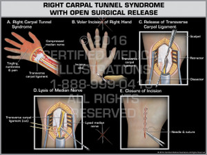 Exhibit of Right Carpal Tunnel Syndrome with Open Surgical Release - Print Quality Instant Download
