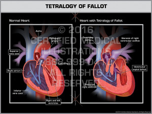 Exhibit of Tetralogy of Fallot - Print Quality Instant Download