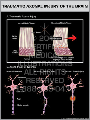 Exhibit of Traumatic Axonal Injury of the Brain Exhibit of Traumatic Axonal Injury of the Brain