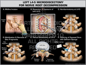 Exhibit of Left L4-5 Microdiscectomy for Nerve Root Decompression Exhibit of Left L4-5 Microdiscectomy for Nerve Root Decompression