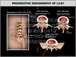Exhibit of Provocative Discography of L3-S1