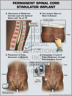 Exhibit of Permanent Spinal Cord Stimulator Implant Exhibit of Permanent Spinal Cord Stimulator Implant