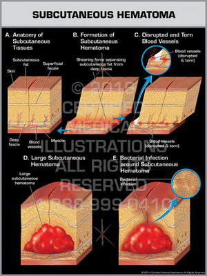 Exhibit of Subcutaneous Hematoma - Print Quality Instant Download Exhibit of Subcutaneous Hematoma - Print Quality Instant Download