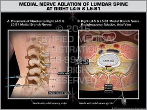 Exhibit of Medial Nerve Ablation of Lumbar Spine at Right L4-5 & L5-S1 - Print Quality Instant Download Exhibit of Medial Nerve Ablation of Lumbar Spine at Right L4-5 & L5-S1 - Print Quality Instant Download