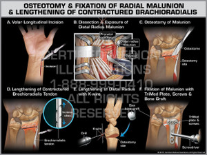 Exhibit of Osteotomy & Fixation of Radial Malunion & Lengthening of Contractured Brachioradialis - Print Quality Instant Download