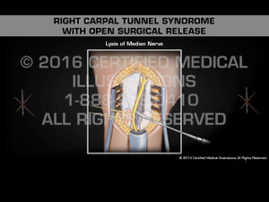 Animation of Right Carpal Tunnel Syndrome with Open Surgical Release - Medical Animation Animation of Right Carpal Tunnel Syndrome with Open Surgical Release - Medical Animation