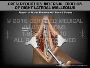 Animation of Open Reduction Internal Fixation of Right Lateral Malleolus - Medical Animation