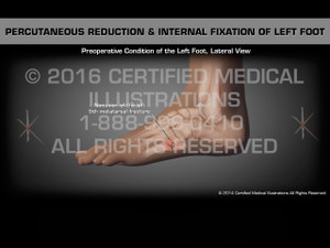 Animation of Percutaneous Reduction & Internal Fixation of Left Foot - Medical Animation Animation of Percutaneous Reduction & Internal Fixation of Left Foot - Medical Animation
