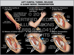 Exhibit of Left Cubital Tunnel Release & Ulnar Nerve Transposition - Print Quality Instant Download Exhibit of Left Cubital Tunnel Release & Ulnar Nerve Transposition - Print Quality Instant Download
