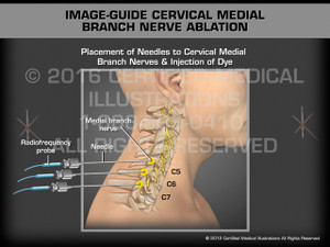Animation of Image-Guide Cervical Medial Branch Nerve Ablation - Medical Animation Animation of Image-Guide Cervical Medial Branch Nerve Ablation - Medical Animation