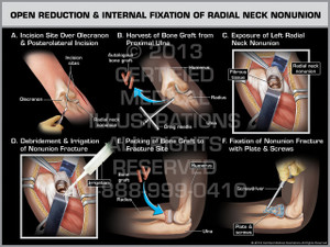 Open Reduction & Internal Fixation of Radial Neck Nonunion