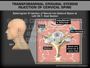 Animation of Transforaminal Epidural Steroid Injection of Cervical Spine - Medical Animation Animation of Transforaminal Epidural Steroid Injection of Cervical Spine - Medical Animation