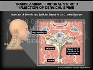 Animation of Translaminal Epidural Steroid Injection of Cervical Spine - Medical Animation