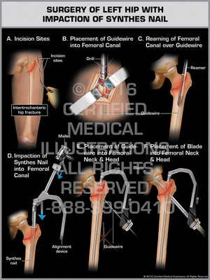 Exhibit of Surgery of Left Hip with Impaction of Synthes Nail