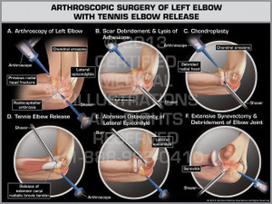 Arthroscopic Surgery of Left Elbow with Tennis Elbow Release Arthroscopic Surgery of Left Elbow with Tennis Elbow Release