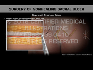 Animation of Surgery of Nonhealing Sacral Ulcer - Medical Animation Animation of Surgery of Nonhealing Sacral Ulcer - Medical Animation