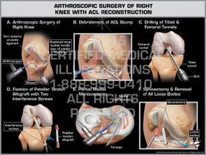 Exhibit of Arthroscopic Surgery of Right Knee with ACL Reconstruction