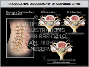 Exhibit of Provocative Discography of Cervical Spine
