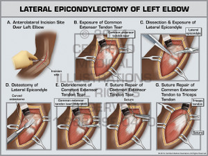 Lateral Epicondylectomy of Left Elbow