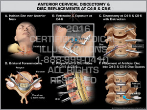 Exhibit of Anterior Cervical Discectomy & Replacement at C4-5 & C5-6 Exhibit of Anterior Cervical Discectomy & Replacement at C4-5 & C5-6