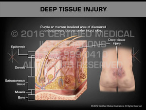 Animation of Deep Tissue Injury - Medical Animation Animation of Deep Tissue Injury - Medical Animation