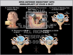 Exhibit of Open Anterior Discectomy with Annuloplasty at C5-C6 & C6-C7