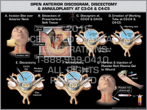 Exhibit of Open Anterior Discogram, Discectomy & Annuloplasty at C3-C4 & C4-C5